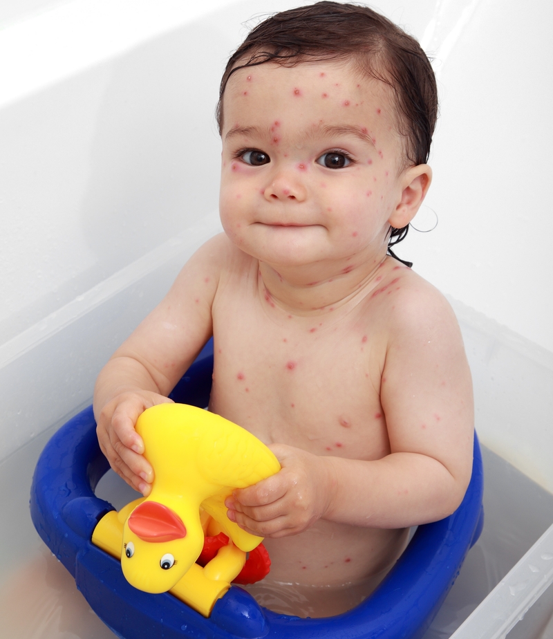 Relieve Chicken Pox | hartphotography/Shutterstock